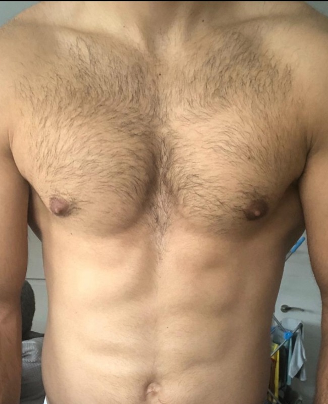 Whistles Laser Clinic - Before Chest